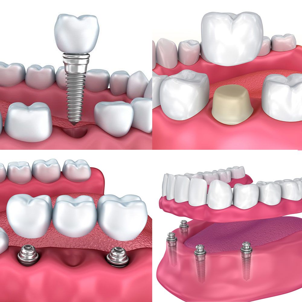 implant-supported restorations