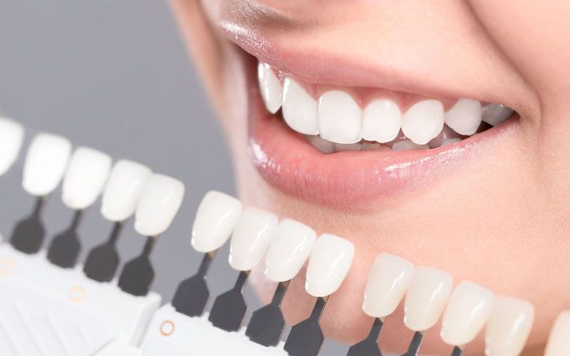 A dental shade guide is placed next to a patient's smile.
