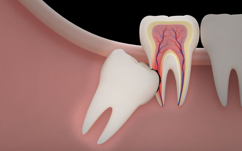 An impacted wisdom tooth is trapped beneath the gums and damages its neighbor.