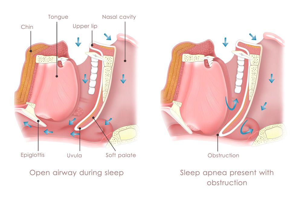 open airway vs. sleep apnea