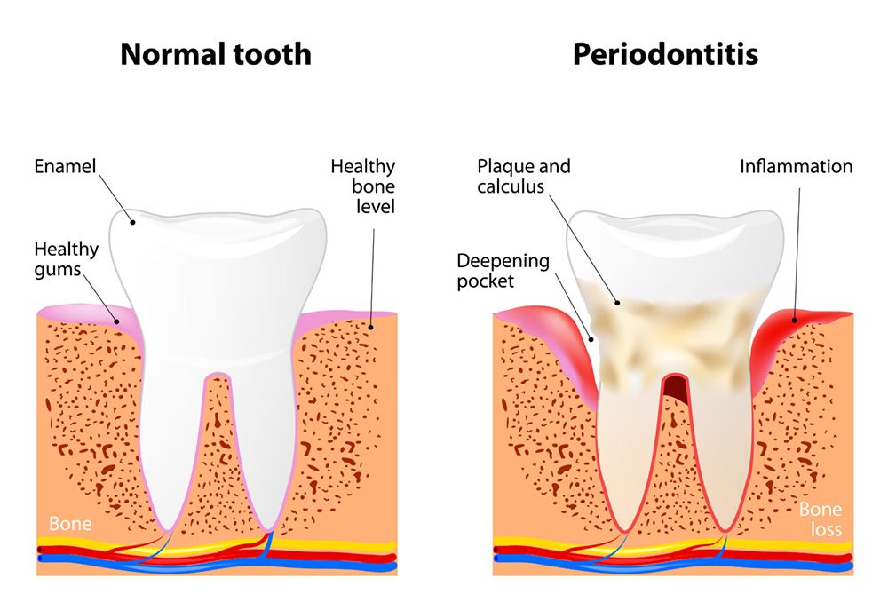 normal vs. diseased tooth